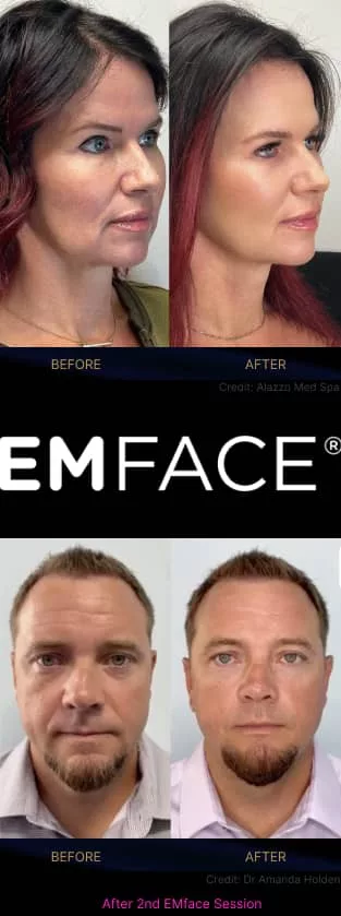 EMface before and after results