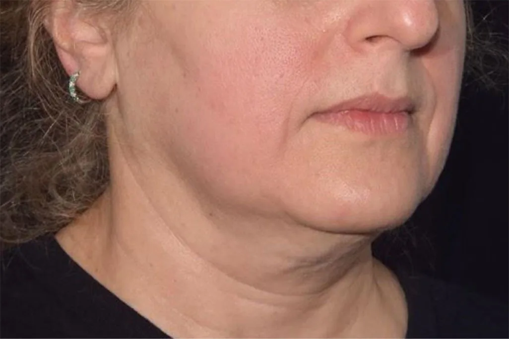 After EMface Submentum