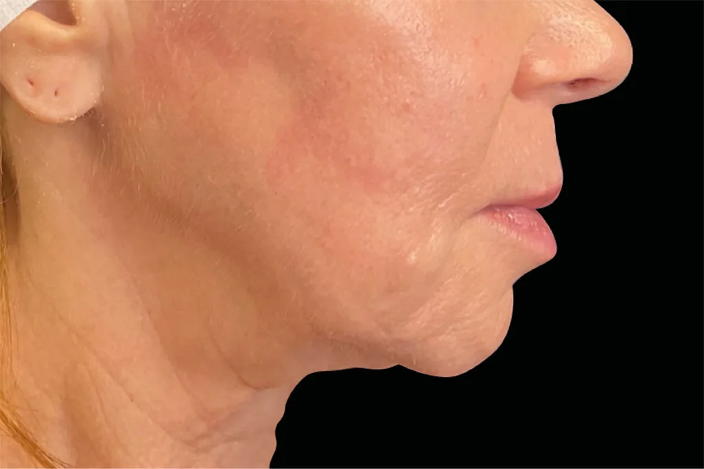 After EMface Submentum