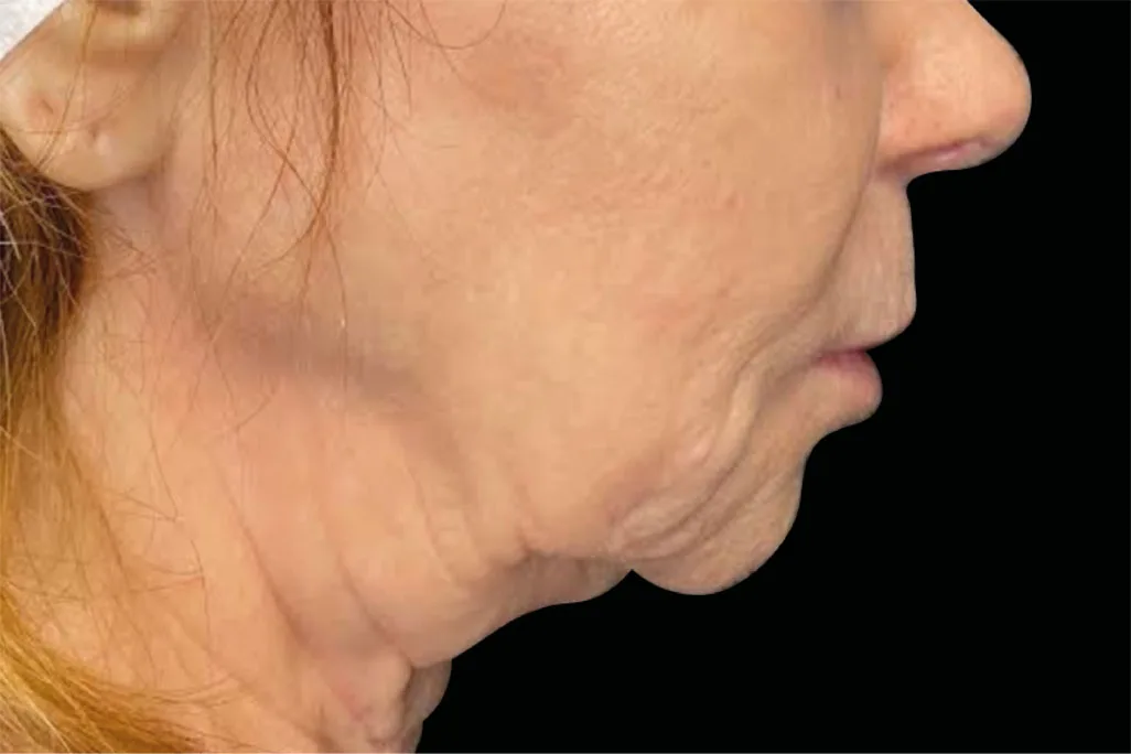 Before EMface Submentum