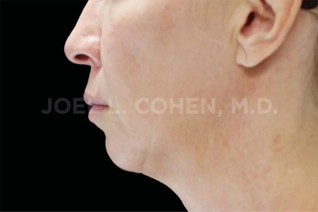 Before EMface Submentum